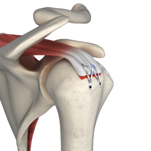 RapidFix Knotless  Rotator Cuff Repair